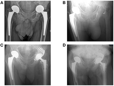 Pharmacokinetic/Pharmacodynamic Dosage Individualization of Suppressive Beta-Lactam Therapy Administered by Subcutaneous Route in Patients With Prosthetic Joint Infection